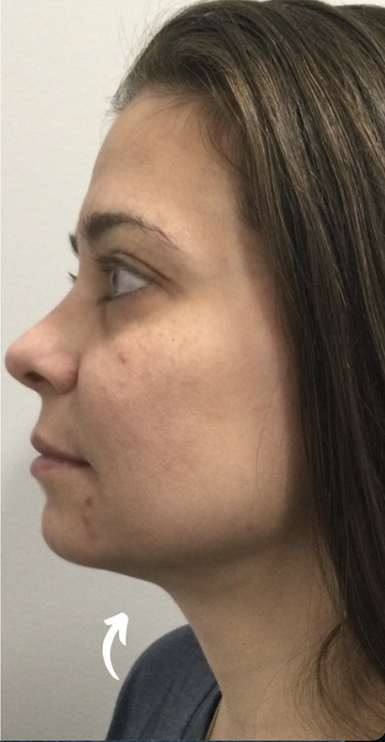 Kybella® After Patient 2