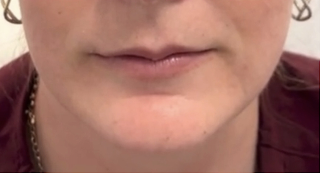 Botox and Dysport Before Patient 15