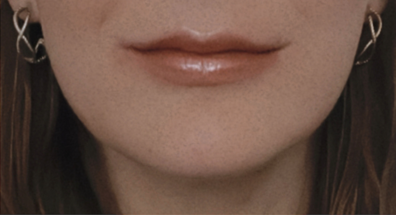 Botox and Dysport After Patient 15