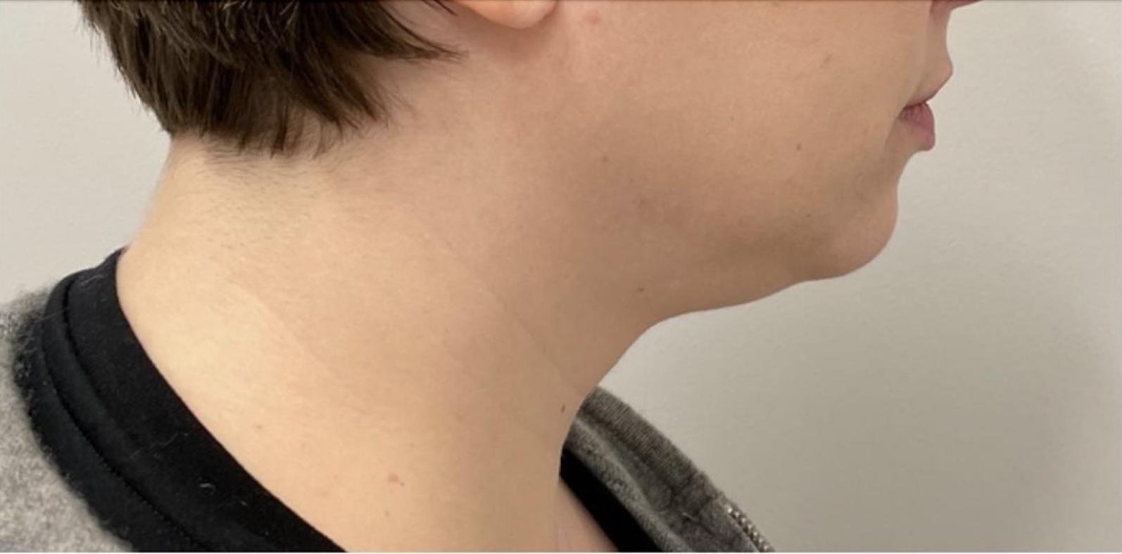 Injectables Before Patient 1