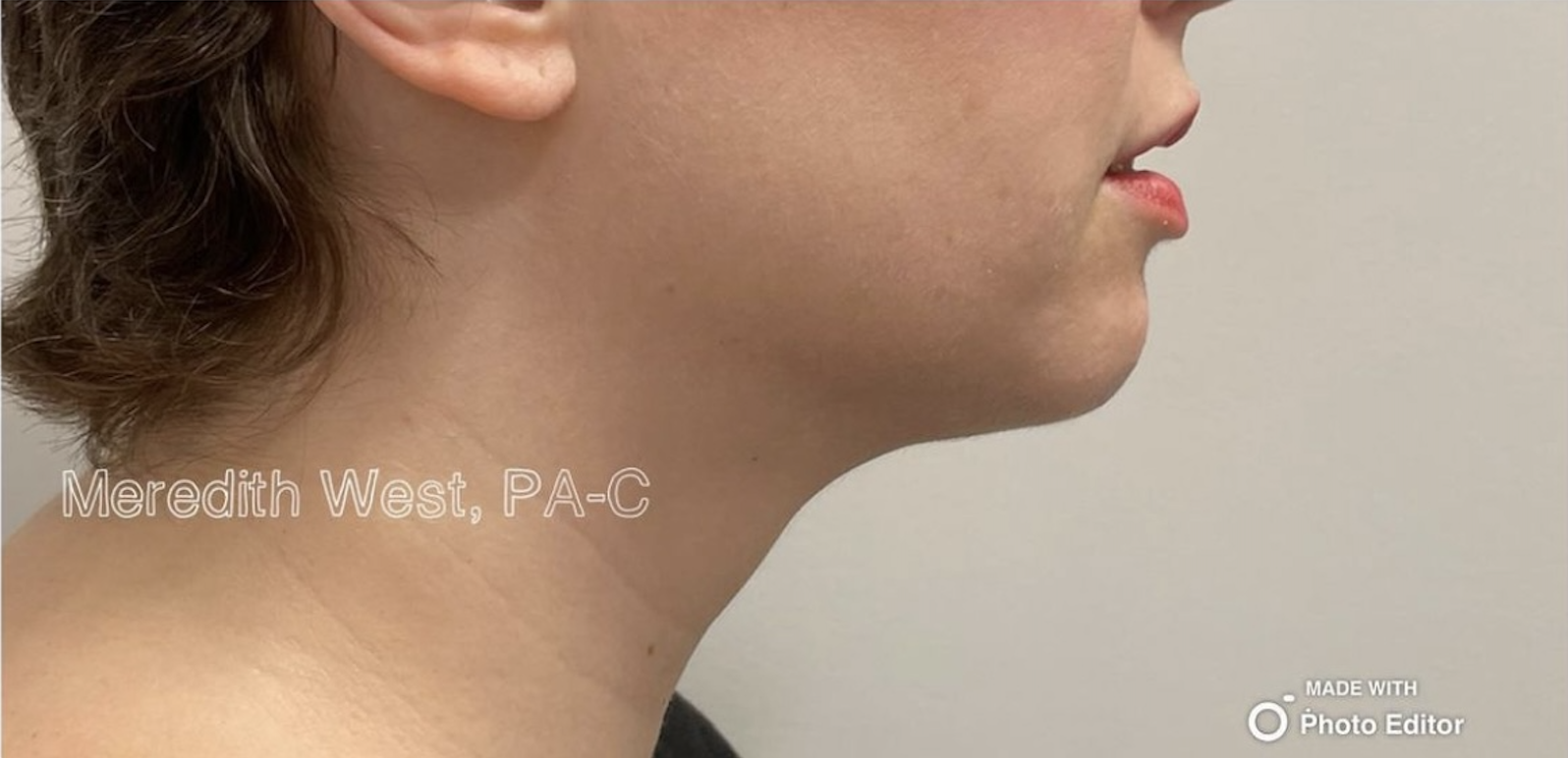Injectables After Patient 1