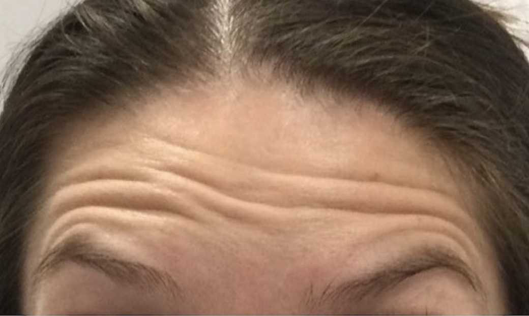 Injectables Before Patient 6