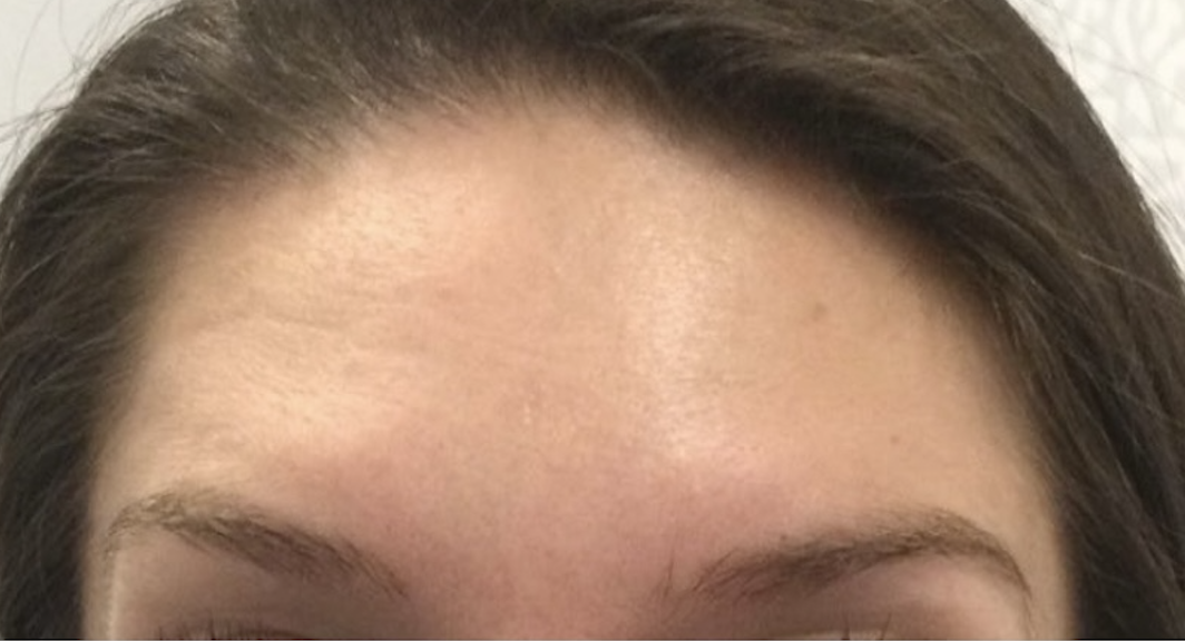 Injectables After Patient 6