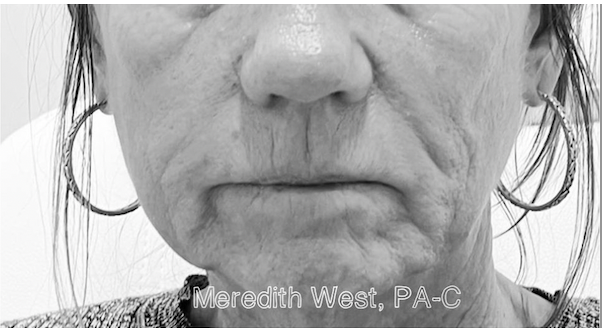 Sculptra Before Patient 1