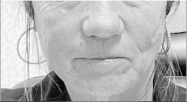 Sculptra After Patient 1