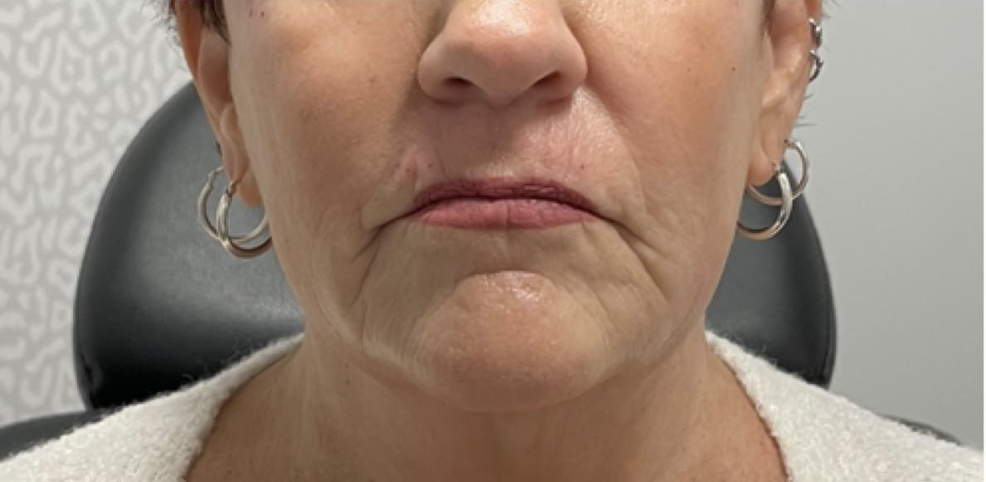 Jawline Filler Before Patient 1
