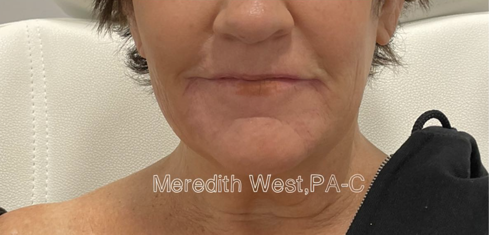Jawline Filler After Patient 1