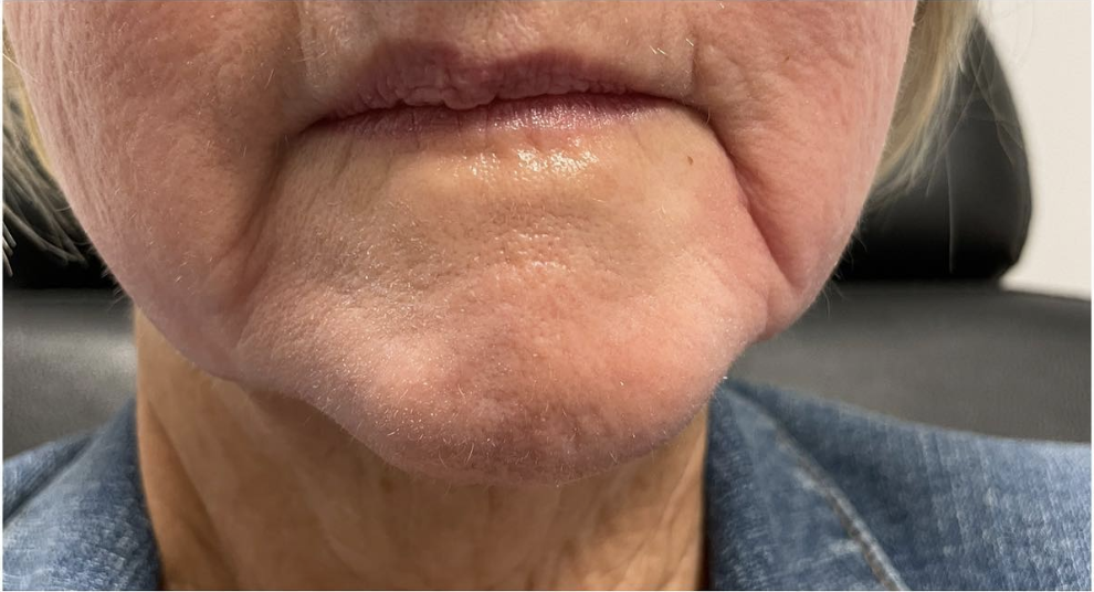 Marionette Lines Before Patient 5