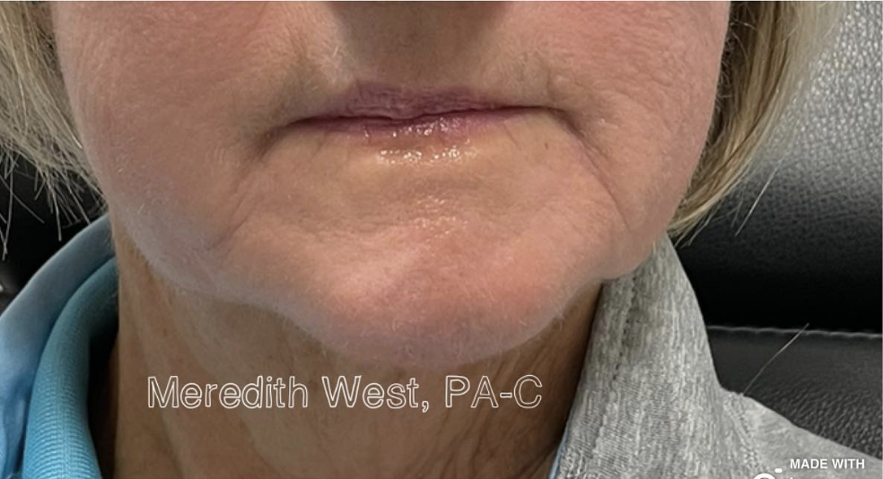 Marionette Lines After Patient 5