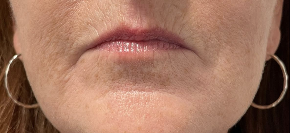 Marionette Lines Before Patient 6