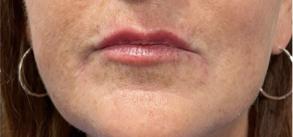 Marionette Lines After Patient 6