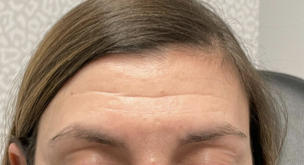 Injectables Before Patient 3