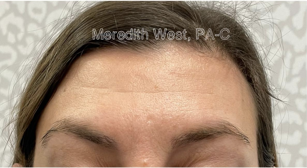 Injectables After Patient 3