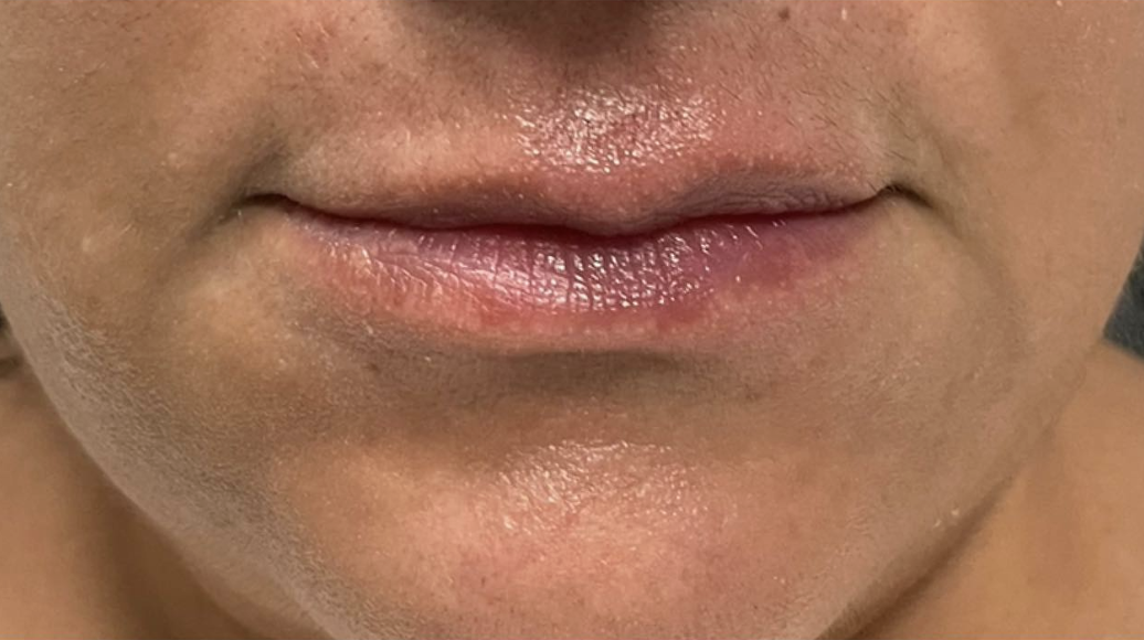 Injectables Before Patient 8