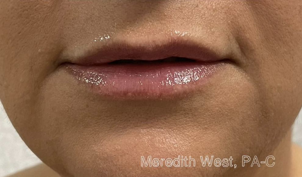 Injectables After Patient 8