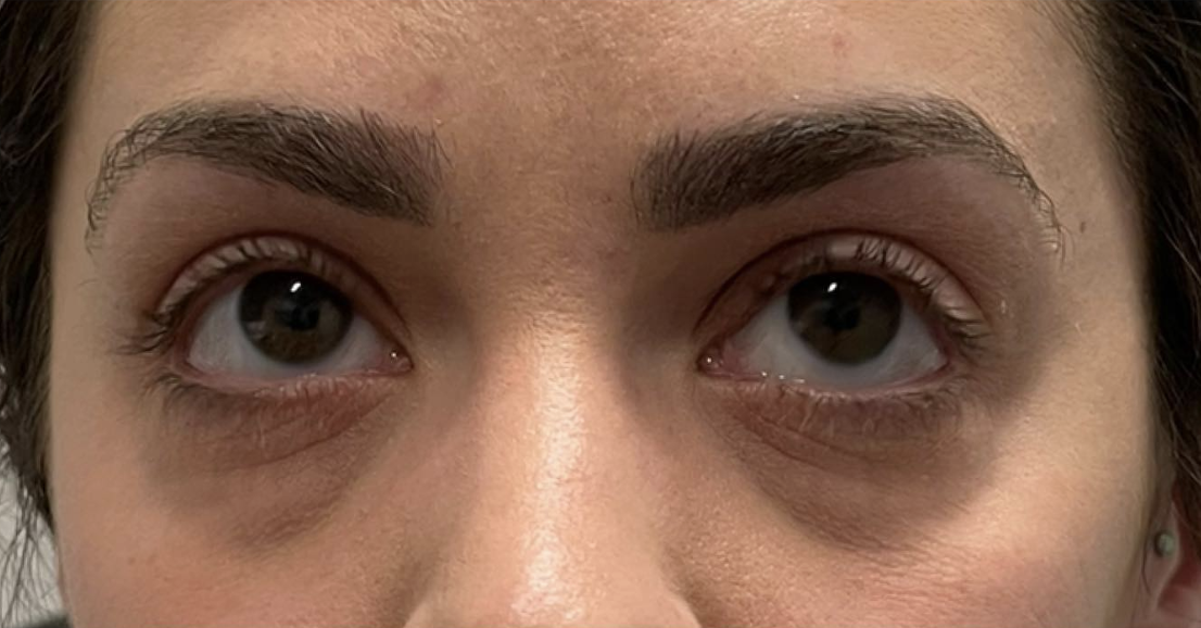 PRF for Undereyes Before Patient 4