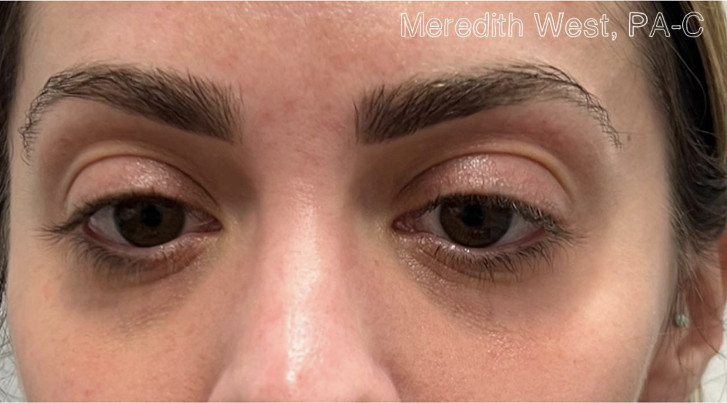 PRF for Undereyes After Patient 4