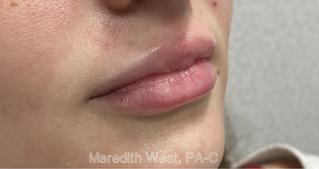 Lip Filler Before Patient 12