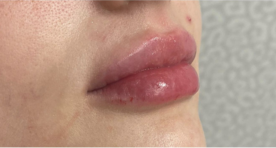 Lip Filler After Patient 12