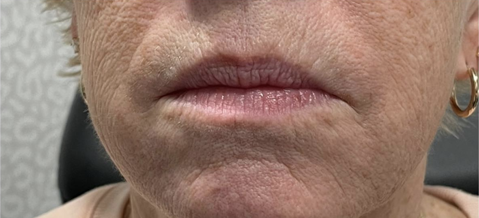 Lip Filler Before Patient 31