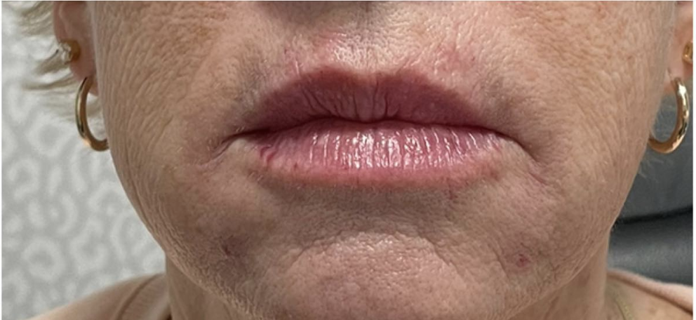 Lip Filler After Patient 31