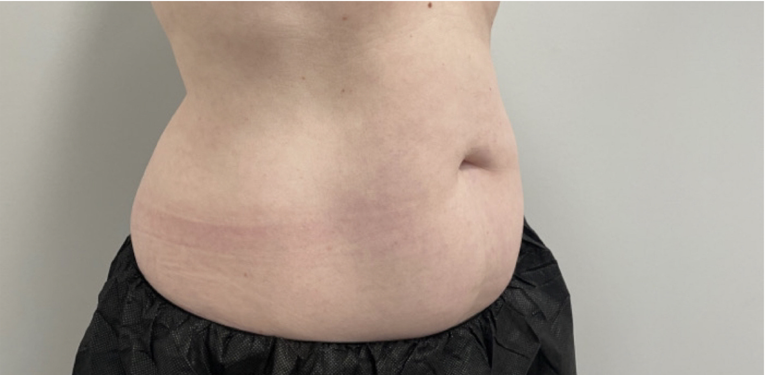 CoolSculpting Before Patient 8