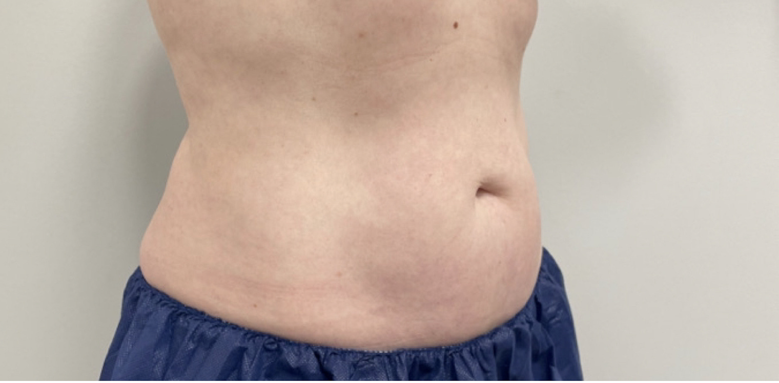 CoolSculpting After Patient 8