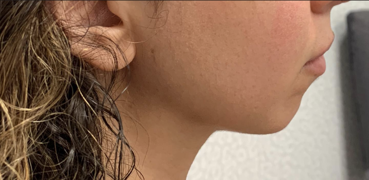 Chin Filler Before Patient 1