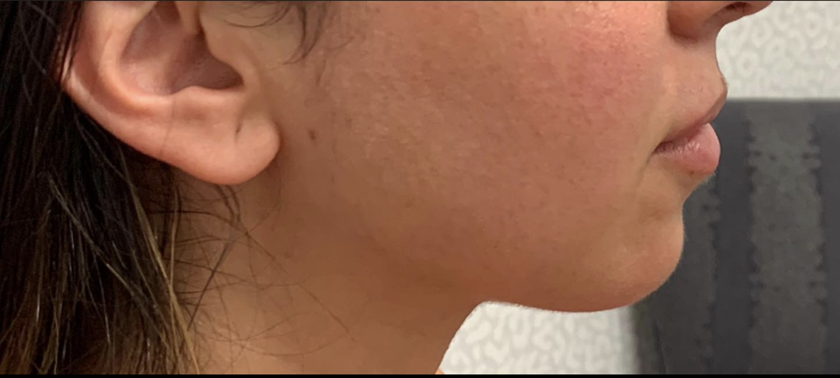 Chin Filler After Patient 1