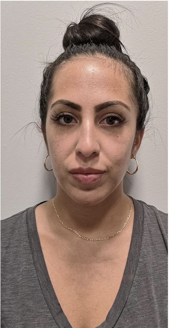 Jawline Filler Before Patient 2