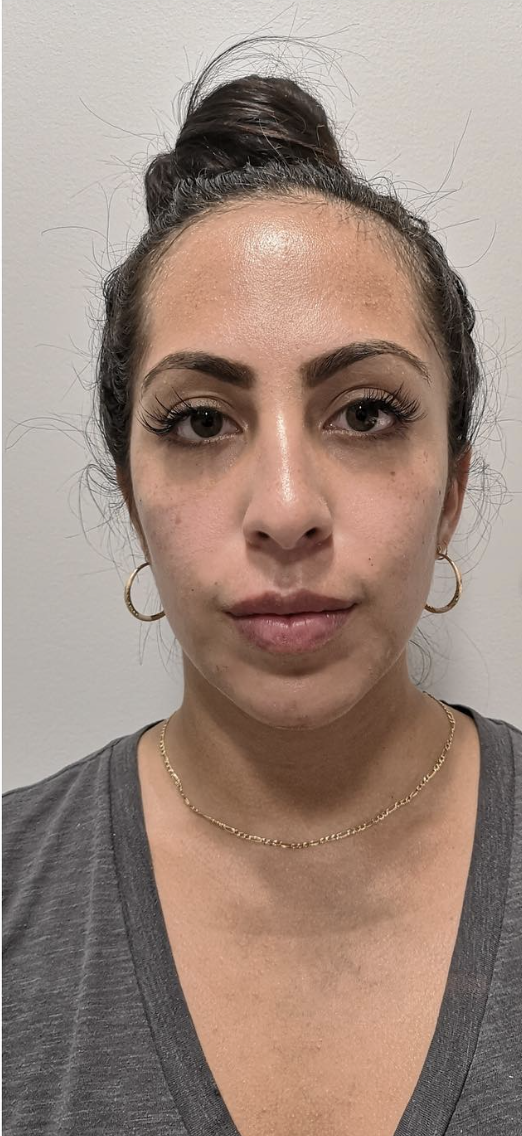 Jawline Filler After Patient 2