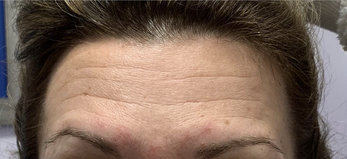 Botox and Dysport Before Patient 8
