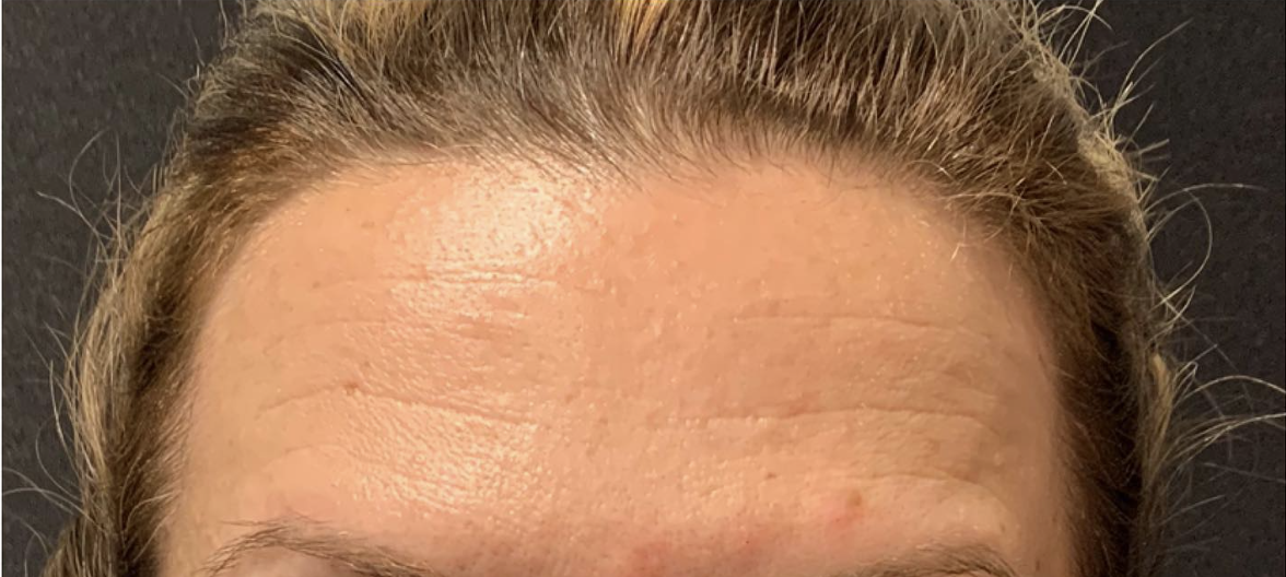 Botox and Dysport After Patient 8