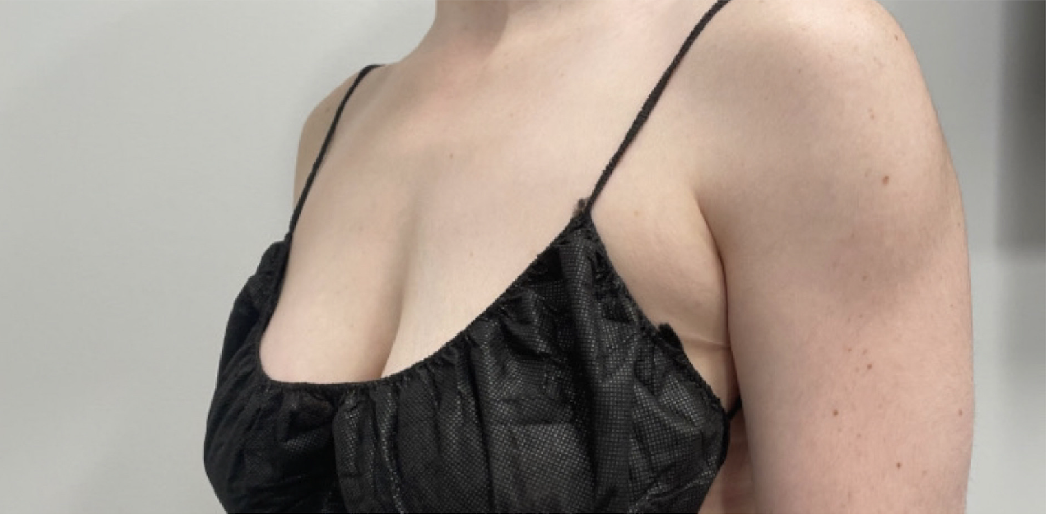 CoolSculpting Before Patient 1