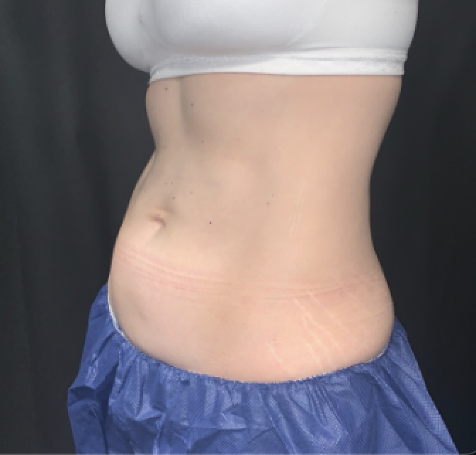 CoolSculpting After Patient 2