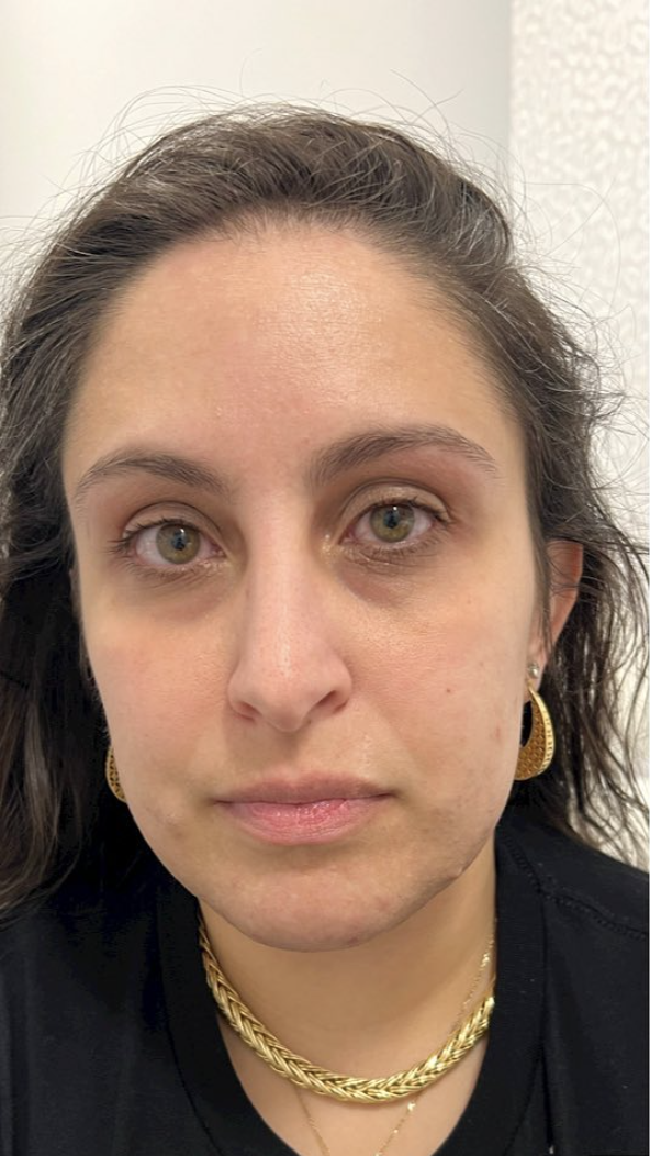 Injectables Before Patient 4