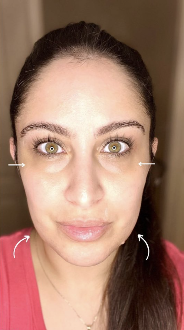 Injectables After Patient 4