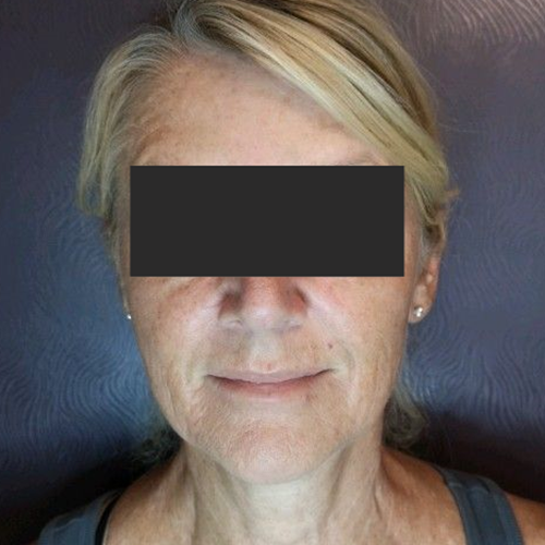 Medical Spa After Patient 7