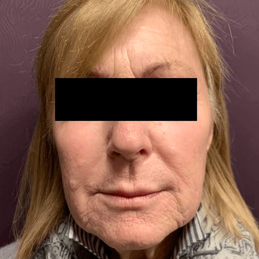 Medical Grade Skin Care After Patient 1