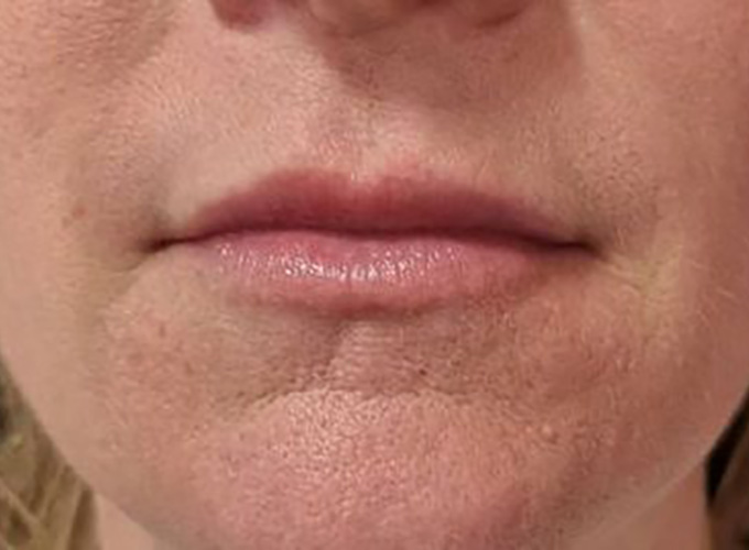 Lip Filler After Patient 30