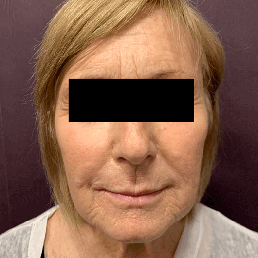 Medical Grade Skin Care Before Patient 1