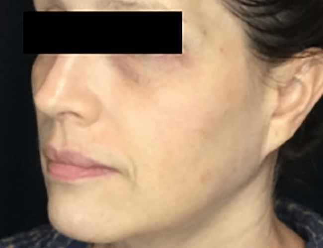 Microneedling Before Patient 2