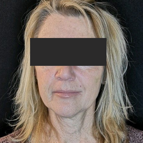 Medical Spa Before Patient 7