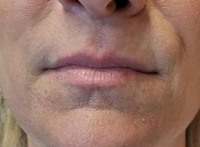 Lip Filler Before Patient 30