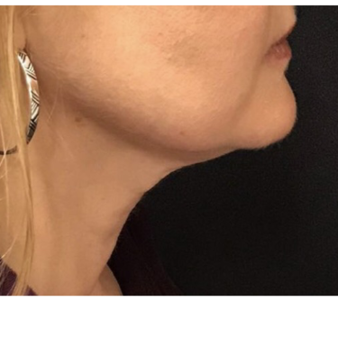 Kybella® After Patient 1