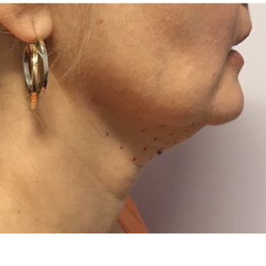 Kybella® Before Patient 1