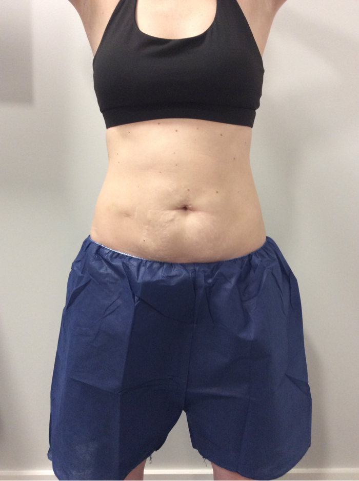CoolSculpting After Patient 6