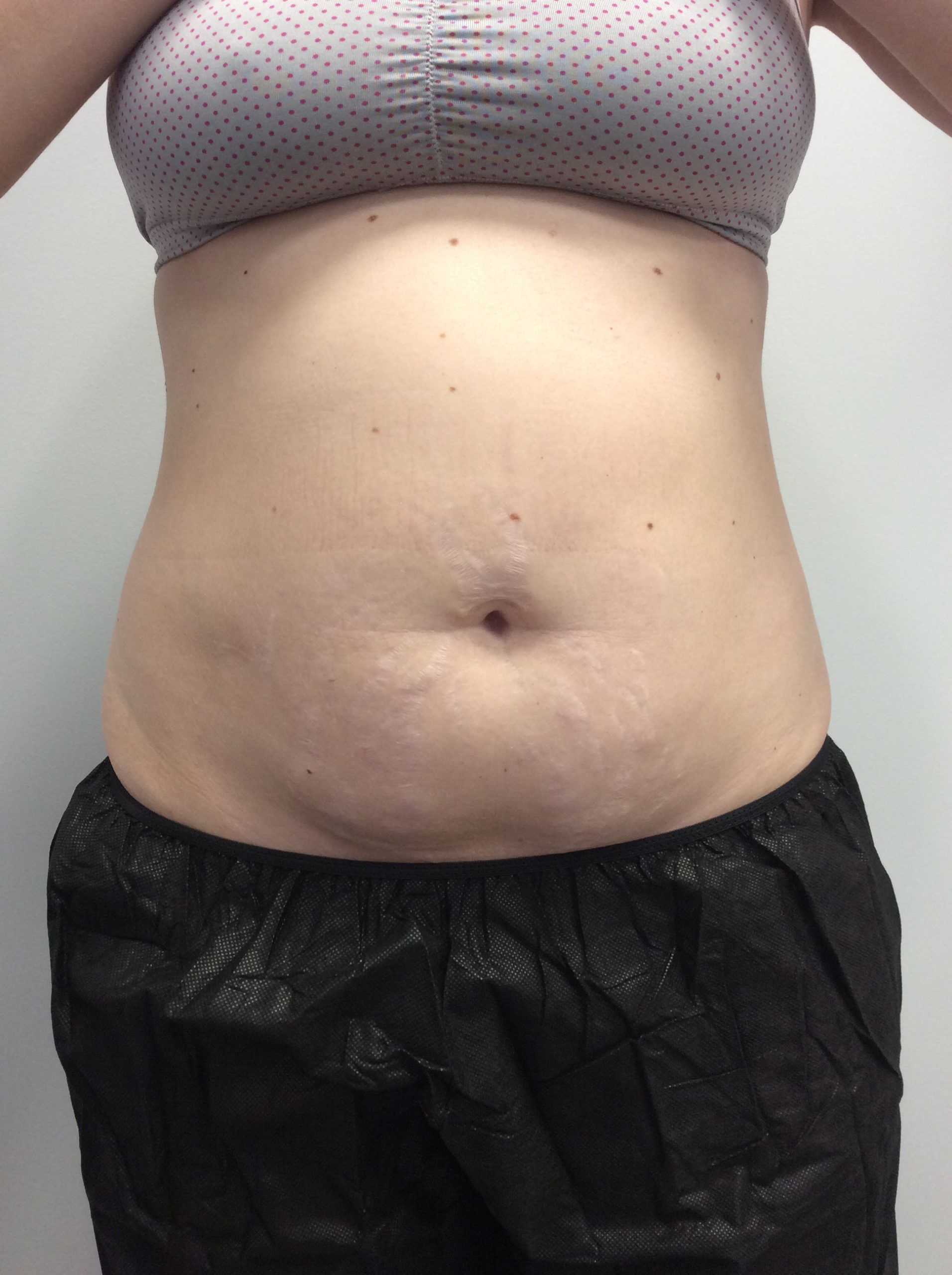 CoolSculpting Before Patient 6