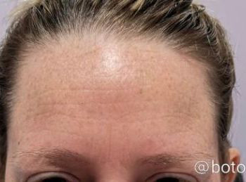 Injectables After Patient 16