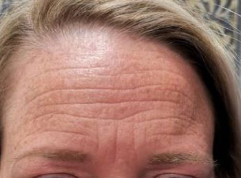 Injectables Before Patient 16